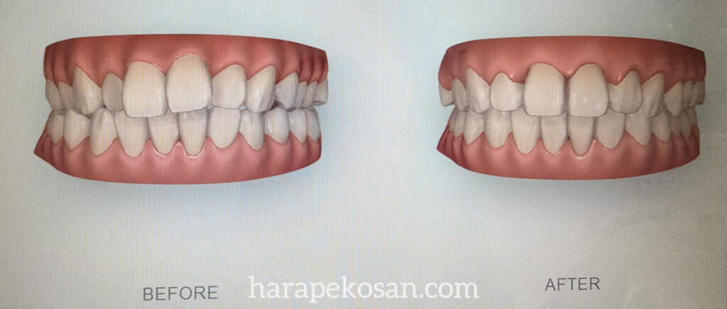 歯列矯正前と後のイメージ画像